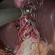 Single Incision Laparoscopic Cholecystectomy Sils Done By Dr Bijendra