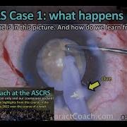 Cataractcoach 1470 Ascrs Case 1 What Happens Next Uday Devgan