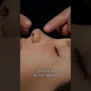 Alectomia Sublimimal