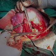 C Section Cesarean Delivery